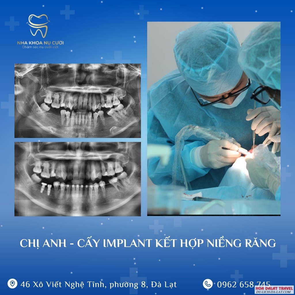 CẤY GHÉP IMPLANT Nha Khoa Nụ Cười