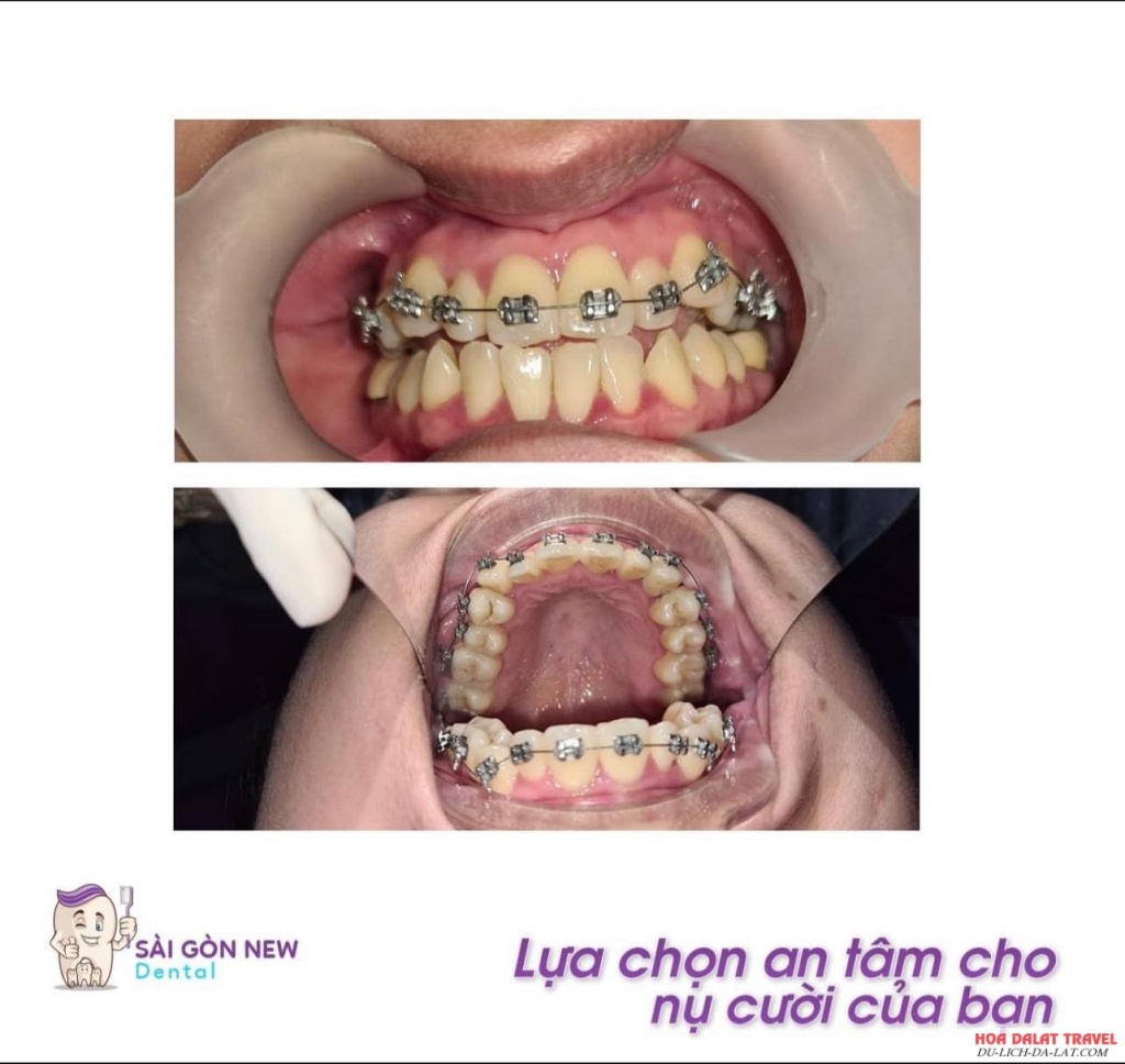 Nha khoa Sài Gòn Đà Lạt