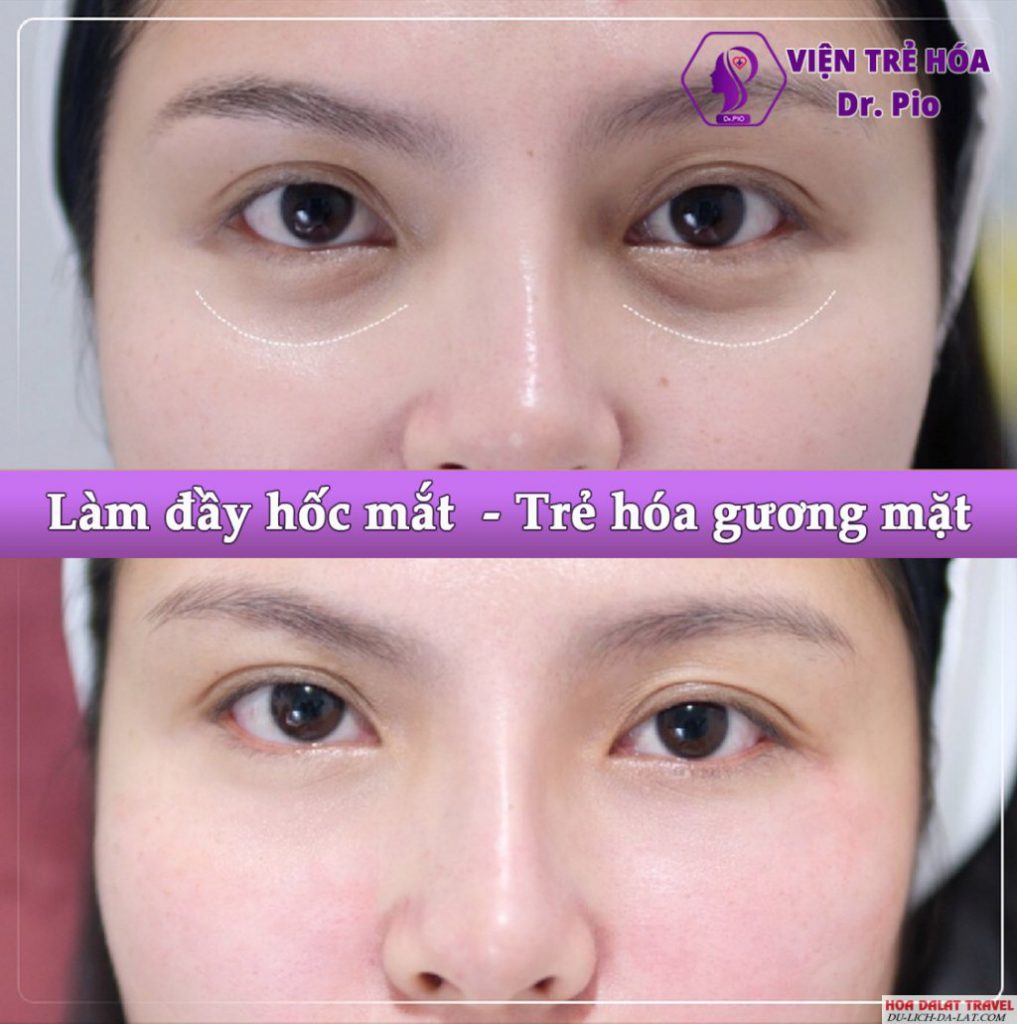 Làm đầy hốc mắt, trẻ hóa gương mặt tại PIO